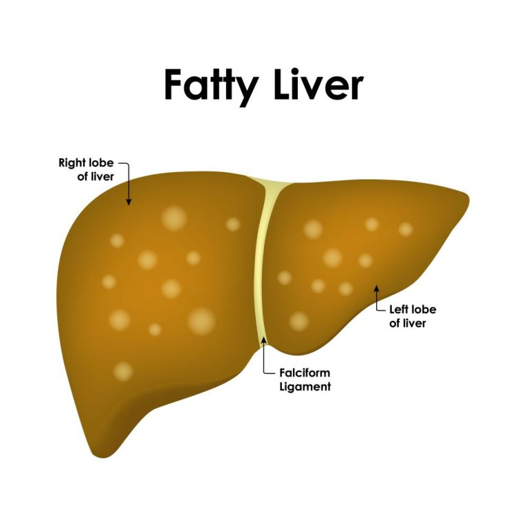 fatty liver